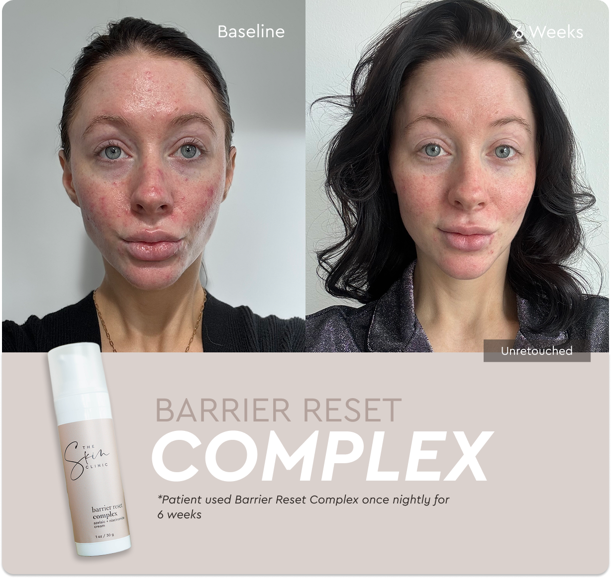 Barrier Reset Complex